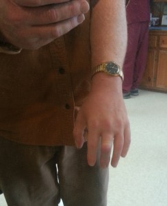 Alatheia client shows his partial hand prosthesis
