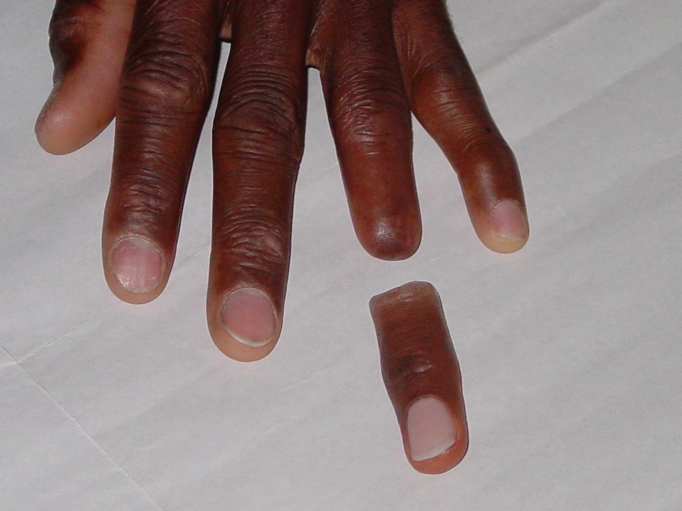 Dermatos® Fingers Alatheia Prosthetic Rehab