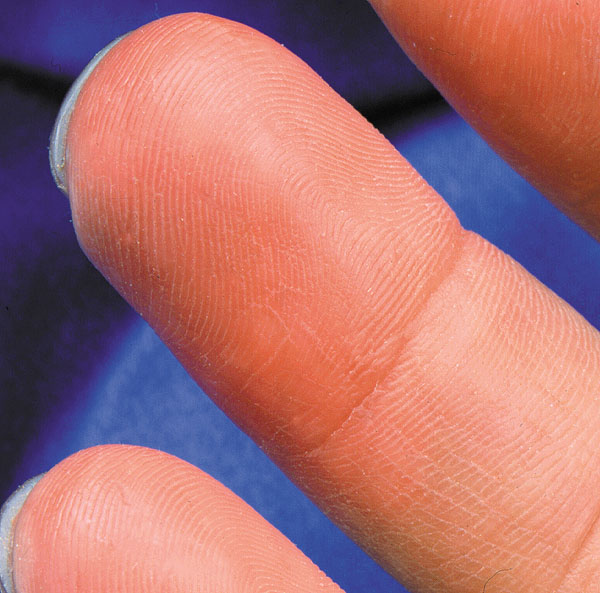 Prosthetic finger tip Alatheia Prosthetic Rehab